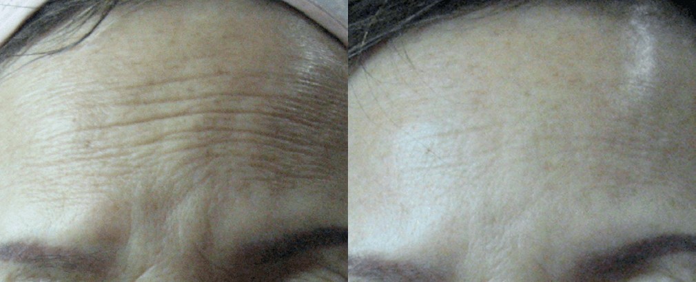 Forehead lines before and after treatment